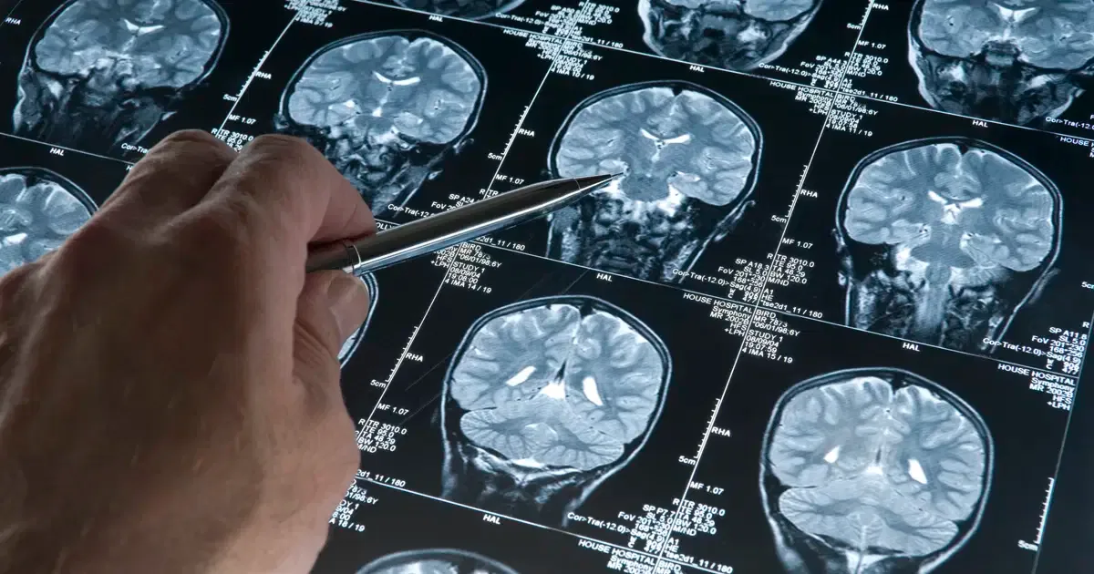 Alzheimer'da gençlik proteini keşfi
